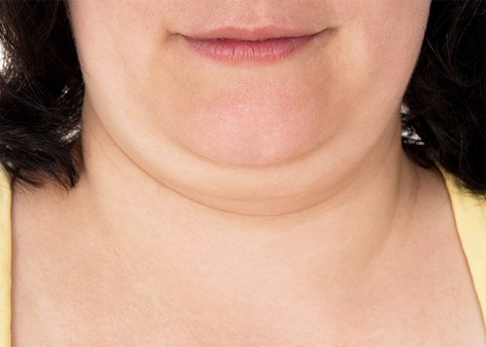 肥満だけじゃない 二重あごの原因になる生活習慣とは クリニックビザリア