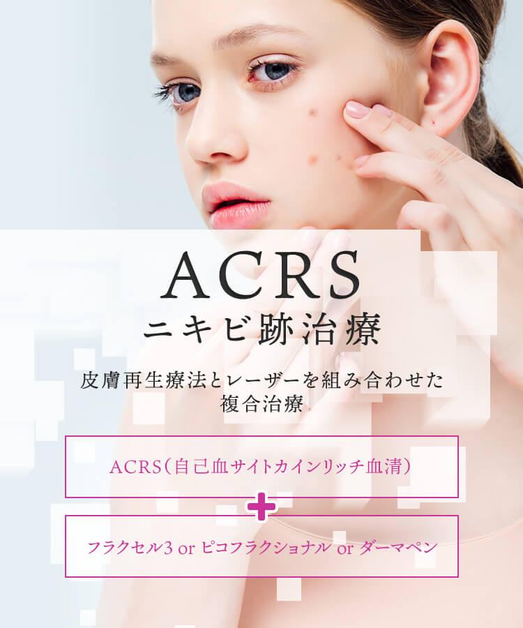 ACRS ニキビ跡改善治療