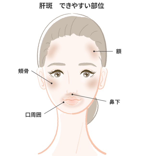 肝斑 できやすい部位