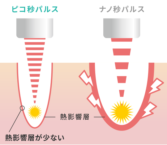 ピコレーザーはターゲットとなるシミやくすみ以外への熱影響が抑えられ、痛みの少ない治療が可能